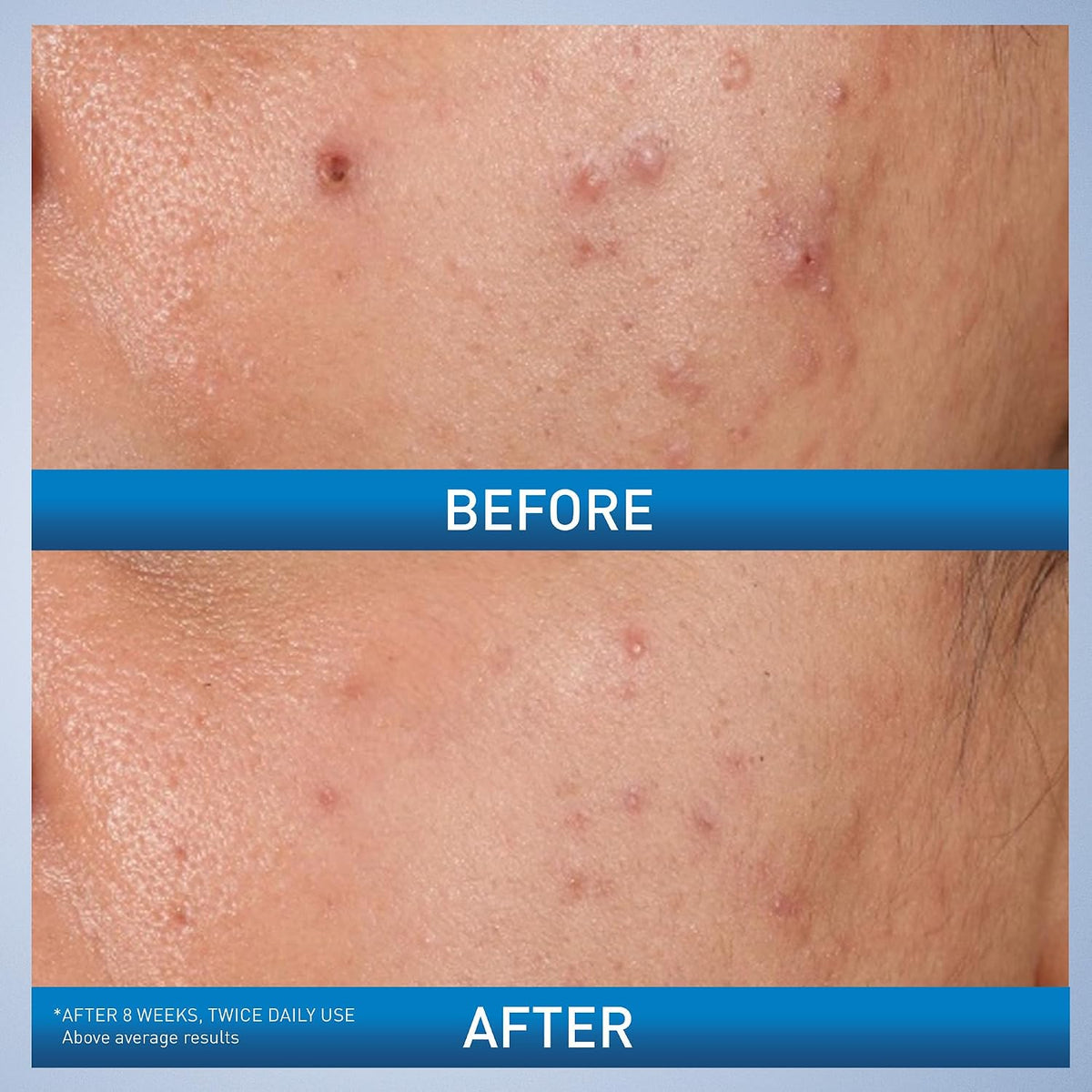 CeraVe Acne Control Gel. Salicylic & Glycolic Acid Face Treatment. 1.35oz | Niacinamide and Lactic Acid Formula Acts As A Face Exfoliator and Pore Minimizer For Face To Clear Stubborn Acne